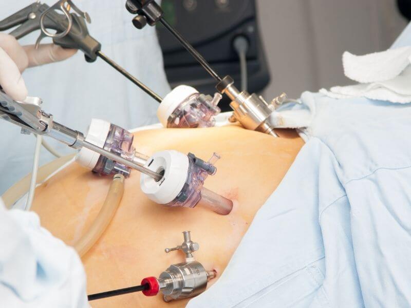 Procedimientos por Laparoscopia en Tijuana