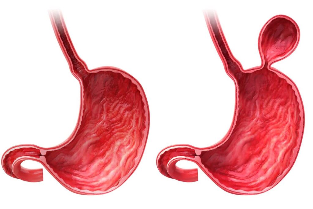 Hernia hiato tratamiento en Tijuana