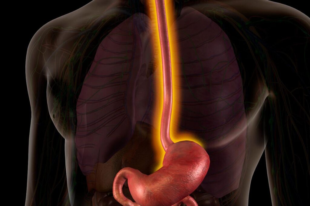 Imagen destacada reflujo gastroesofagico