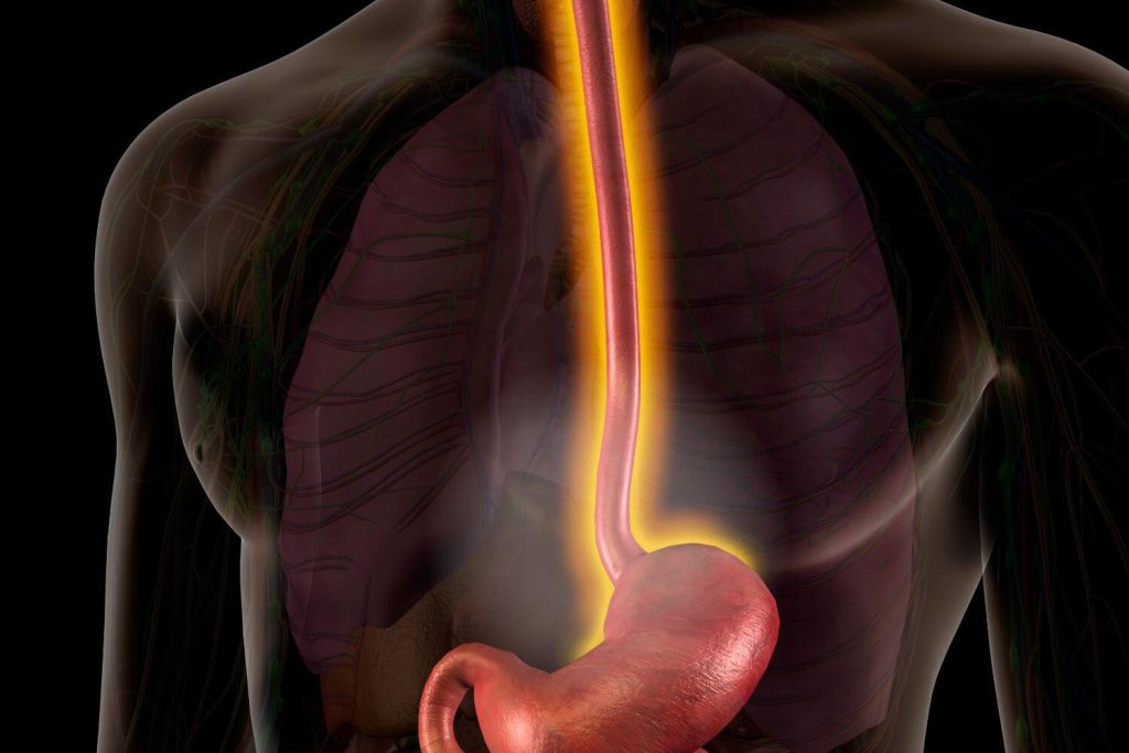 Cirugia por acalasia en Tijuana