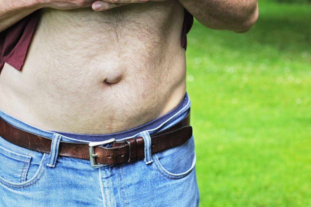 Cirugia de hernia umbilical de adultos en Tijuana